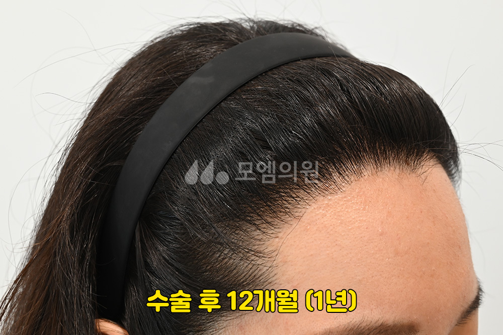 중앙헤어라인 이미지