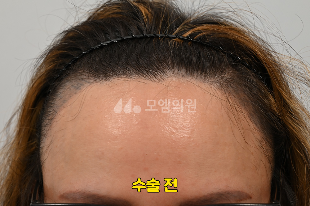 중앙헤어라인 이미지
