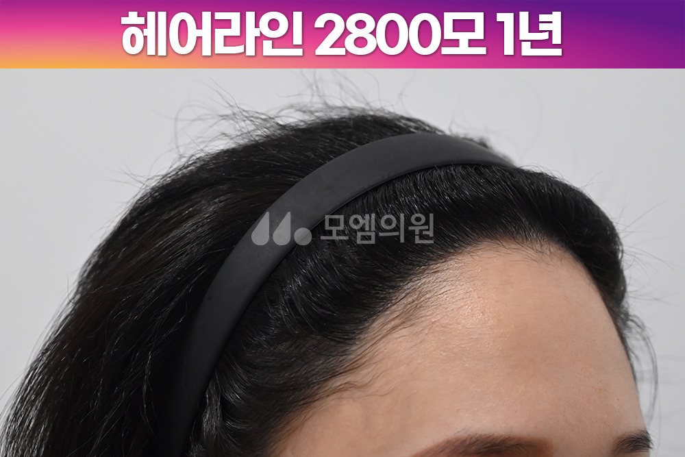 헤어라인 이미지