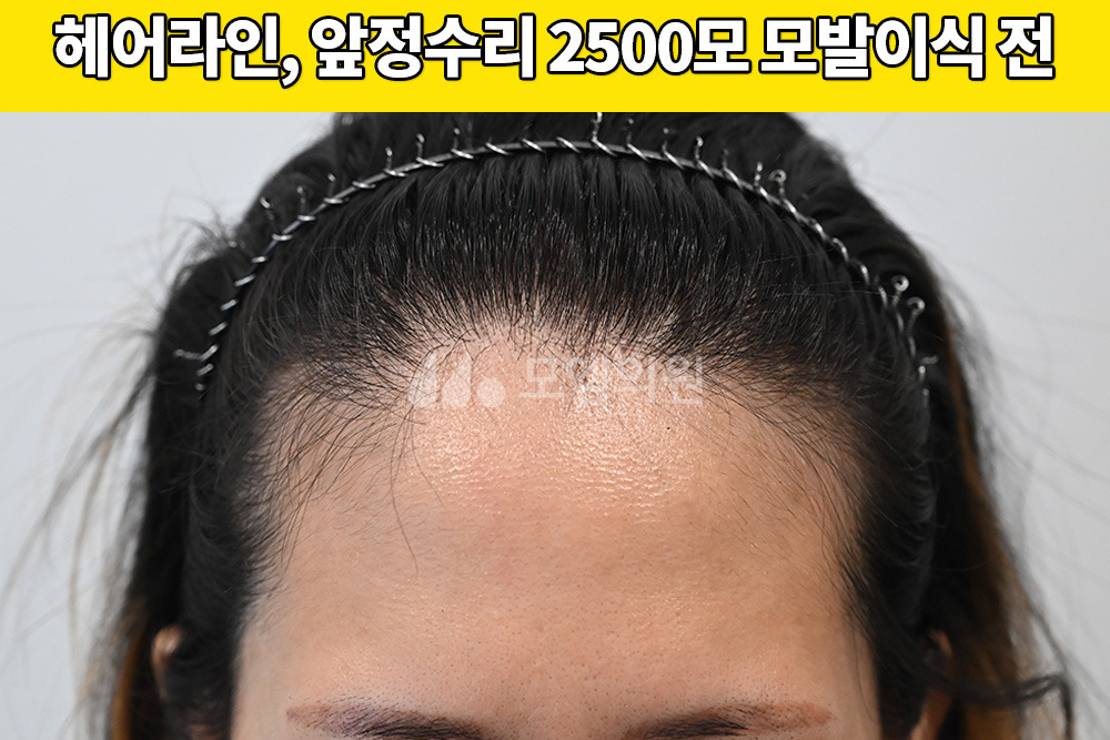중앙헤어라인 이미지