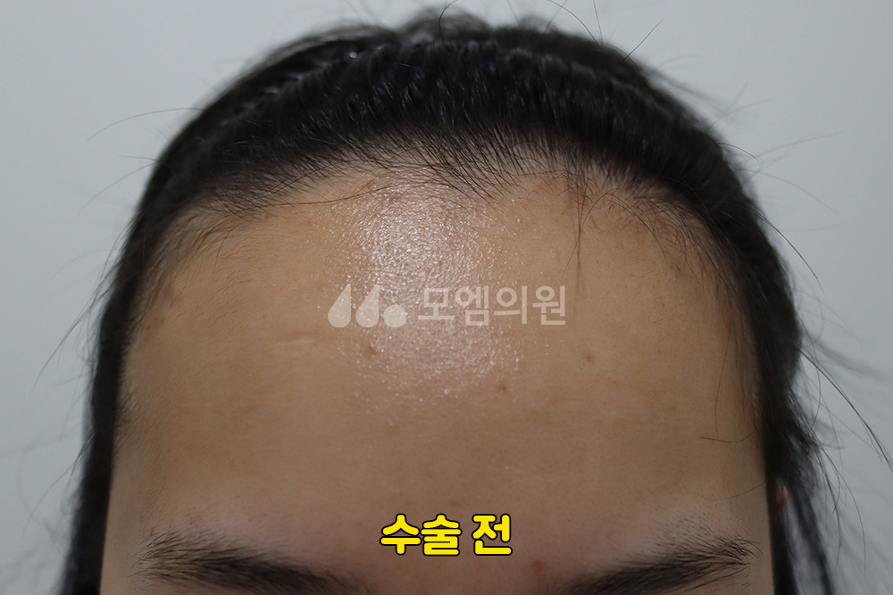 중앙헤어라인 이미지