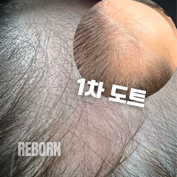 중앙헤어라인 이미지