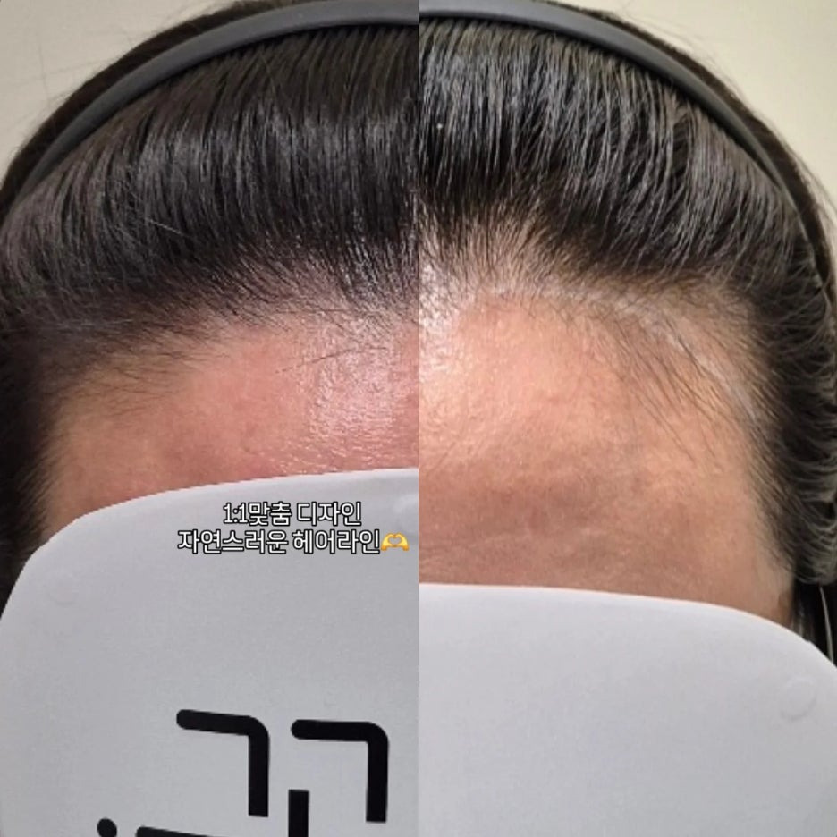 헤어라인 이미지