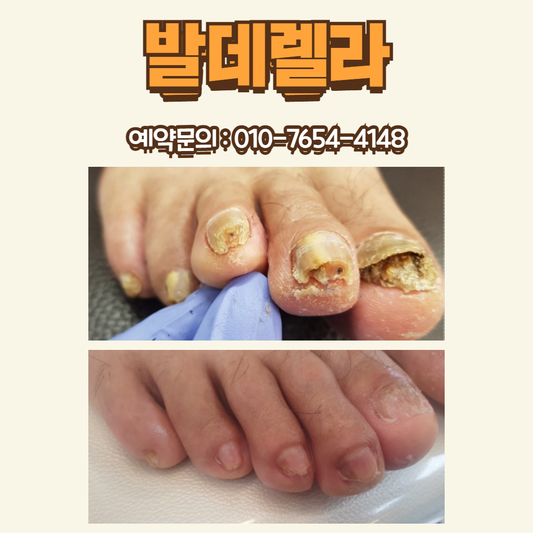 발데렐라 이미지