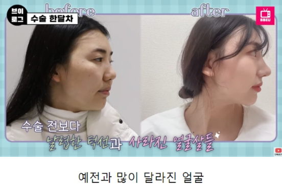외국인들이 한국와서 성형하는 이유 | 인스티즈