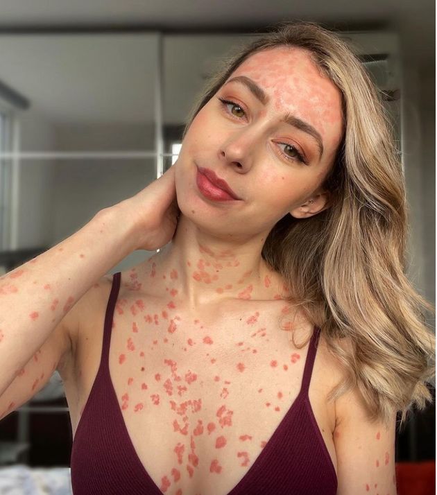 만성 피부병인 '건선'을 앓고 있는 이 여성은 자신의 모습을 당당히 드러낸다 | 인스티즈