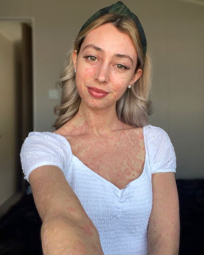 만성 피부병인 '건선'을 앓고 있는 이 여성은 자신의 모습을 당당히 드러낸다 | 인스티즈