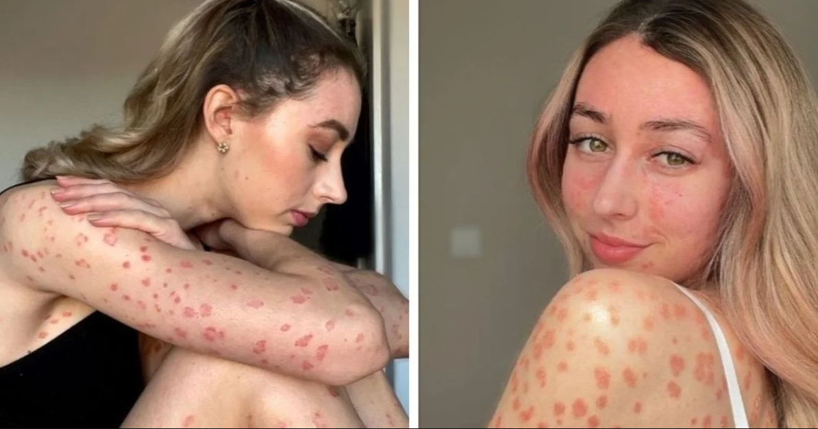 만성 피부병인 '건선'을 앓고 있는 이 여성은 자신의 모습을 당당히 드러낸다 | 인스티즈