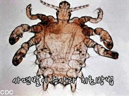 사면발이 확대 모습 .jpg (혐오주의) | 인스티즈