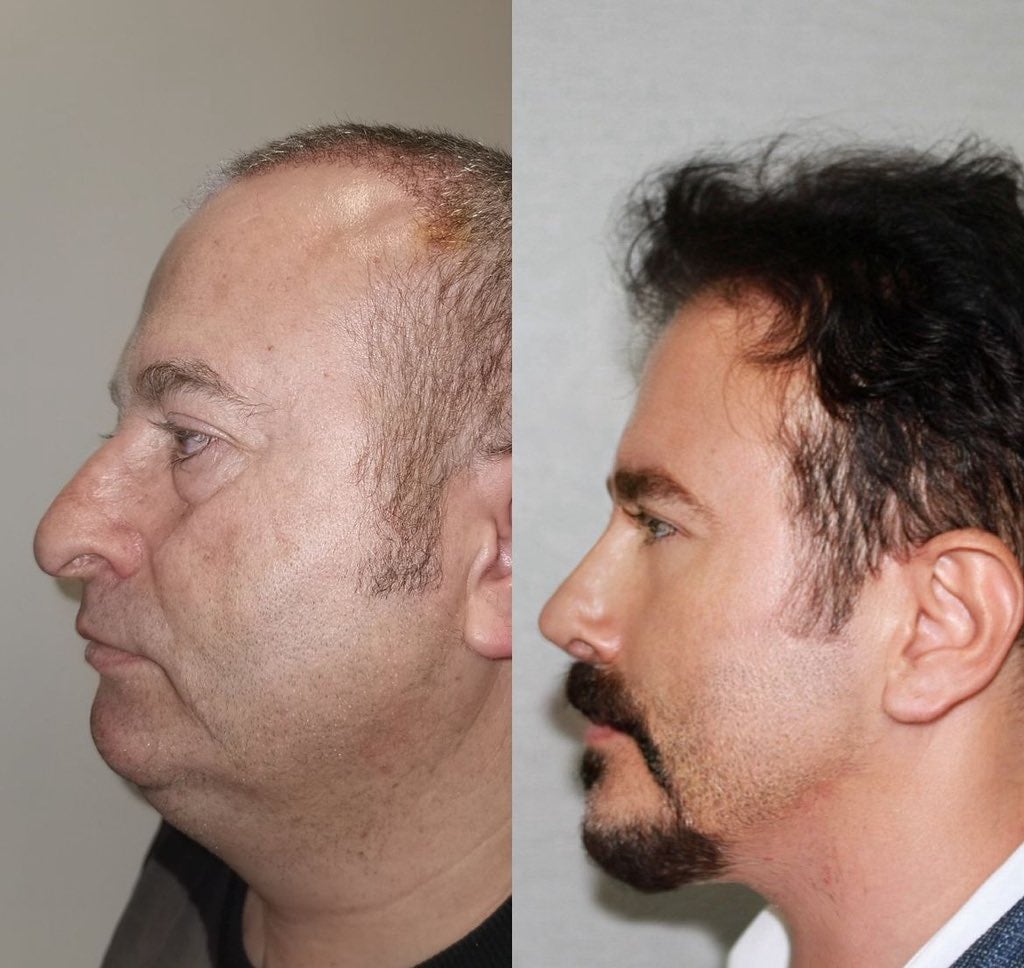 유럽에서 성형 하러 터키로 가는 이유 | 인스티즈