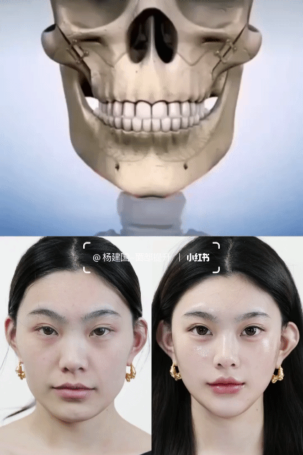 사각턱 , 돌출입 성형 | 인스티즈