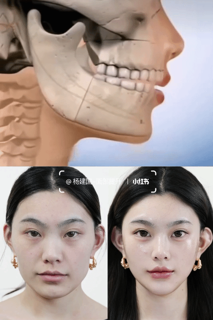 사각턱 , 돌출입 성형 | 인스티즈