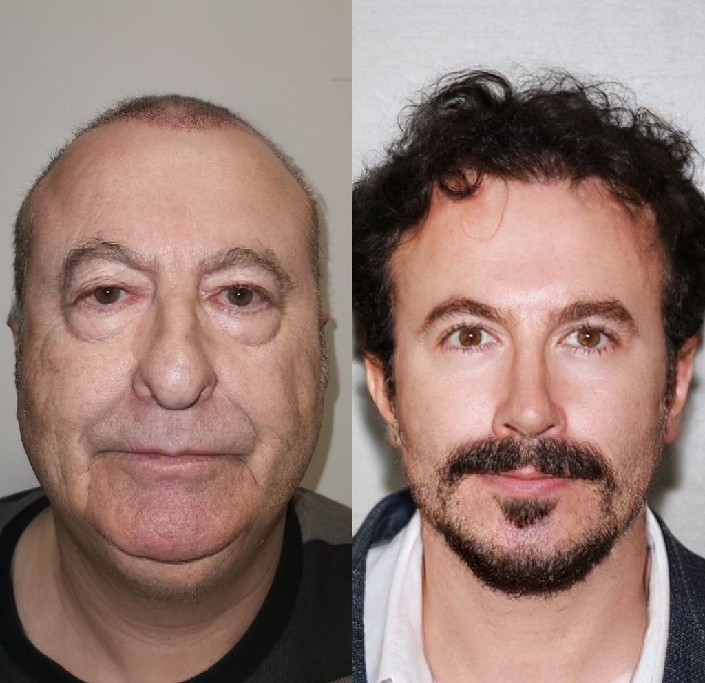 유럽에서 성형 하러 터키로 가는 이유 | 인스티즈