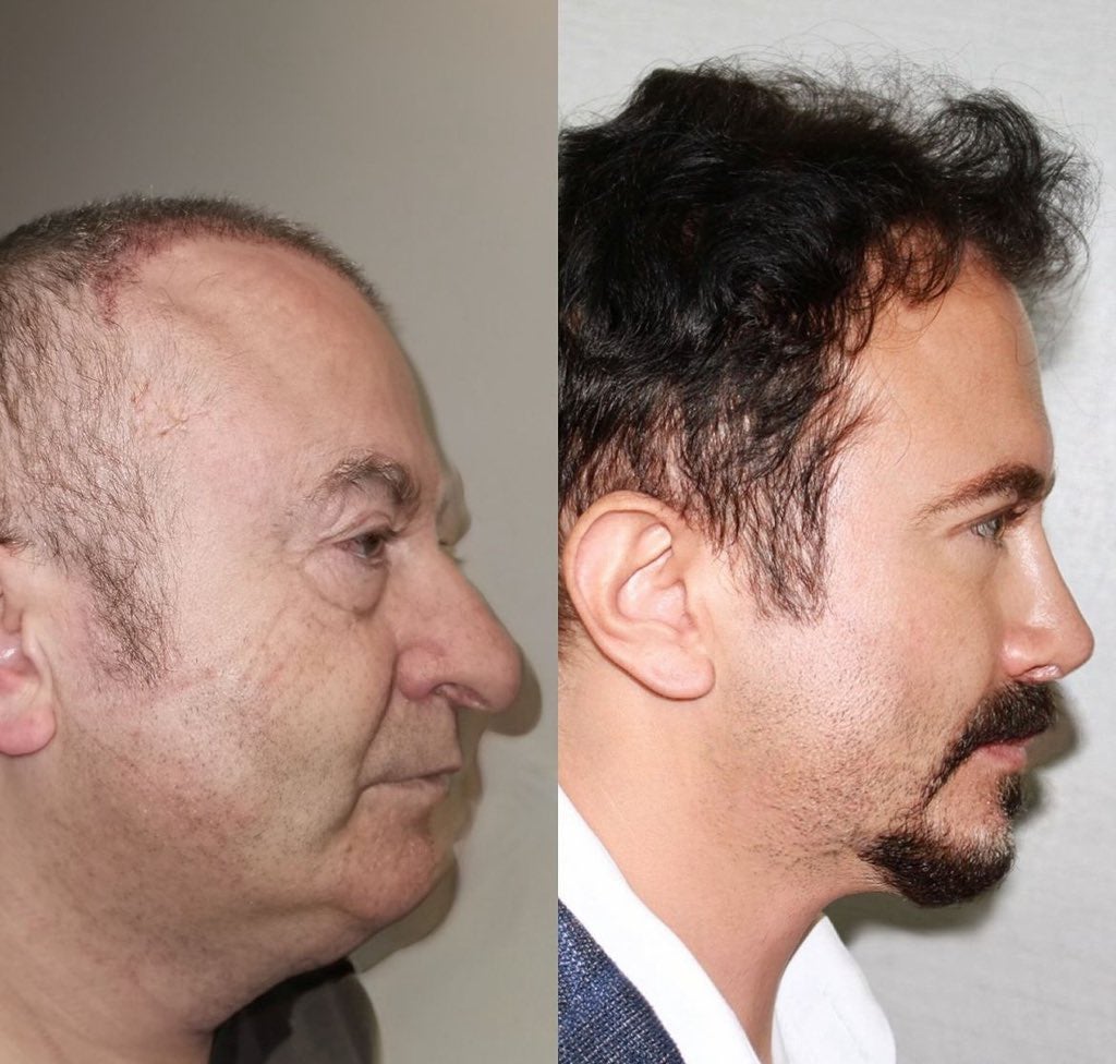 유럽에서 성형 하러 터키로 가는 이유 | 인스티즈