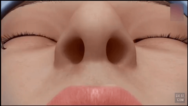 코 성형수술하는 과정.gif | 인스티즈