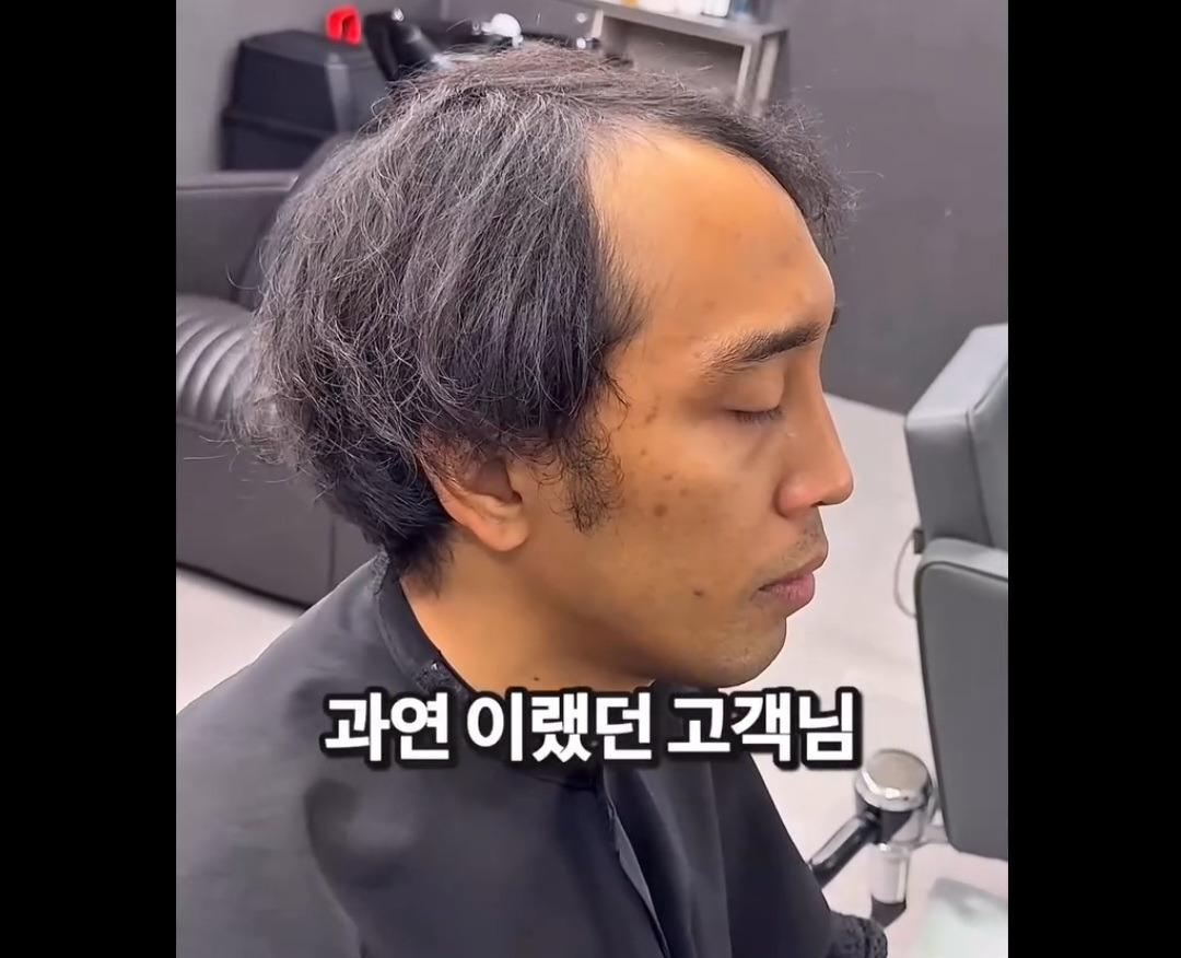 탈모가 있는데 헤어 가능할까요 | 인스티즈