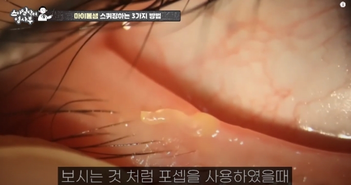 눈꺼풀에도 피지있는거 알아?? jpg (feat. 피르가즘) | 인스티즈