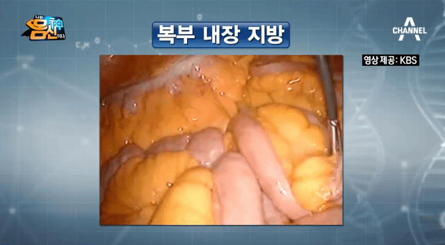 (징그러움 주의) 복부 내장 지방.gif | 인스티즈