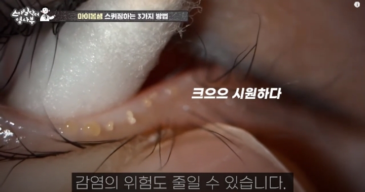 눈꺼풀에도 피지있는거 알아?? jpg (feat. 피르가즘) | 인스티즈