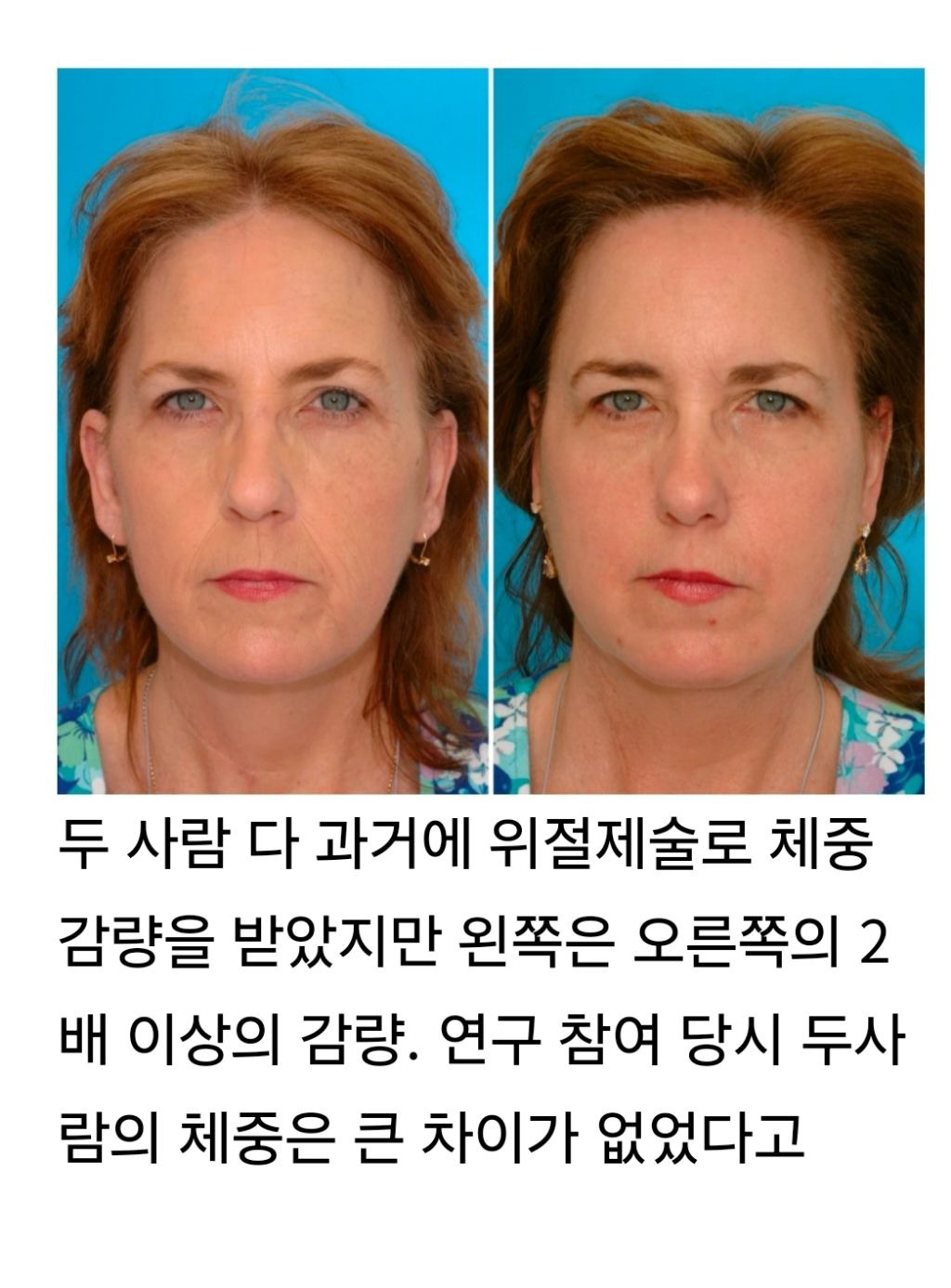 일란성 쌍둥이로 비교한 노화 - 담배, 스트레스, 햇빛, 체중변화 | 인스티즈