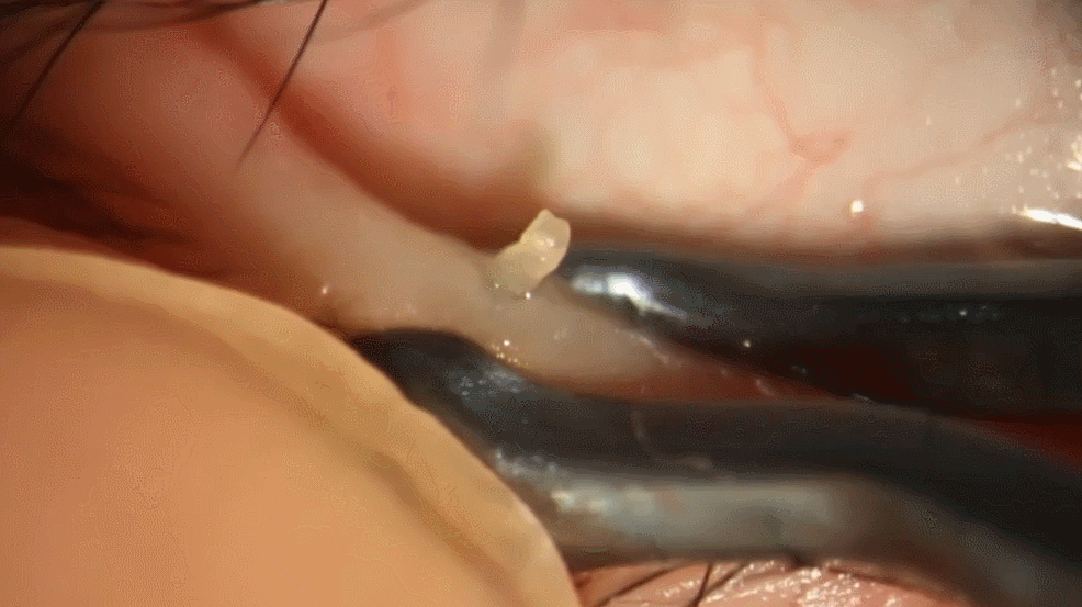 눈꺼풀에도 피지있는거 알아?? jpg (feat. 피르가즘) | 인스티즈