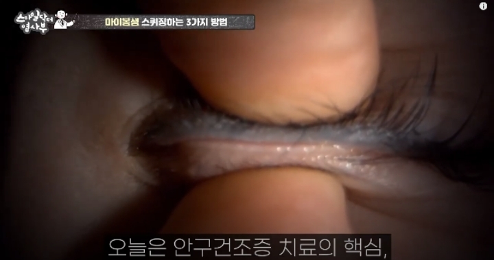 눈꺼풀에도 피지있는거 알아?? jpg (feat. 피르가즘) | 인스티즈