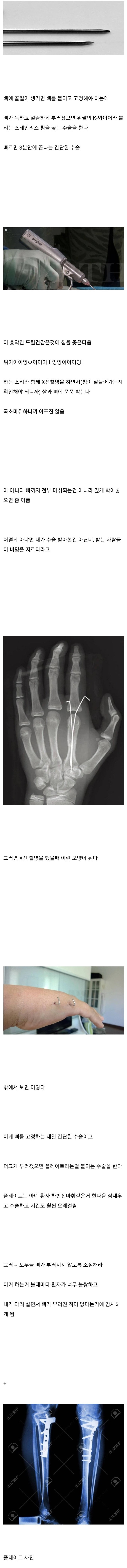 뼈 안 부러져본 사람들이 의외로 모르는 사실들 | 인스티즈