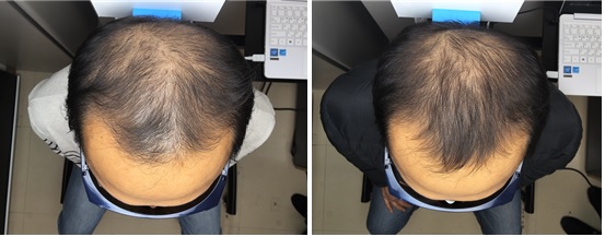 "머리카락 20% 굵어졌다"…LG전자, 탈모치료기 연내 출시 단 | 인스티즈