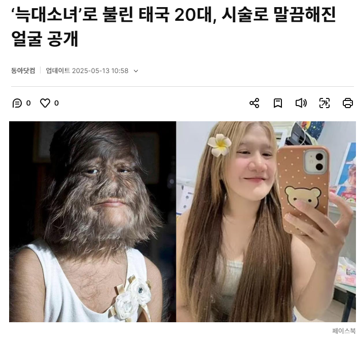 '늑대소녀'로 불린 태국 20대, 시술로 말끔해진 얼굴 공개 | 인스티즈