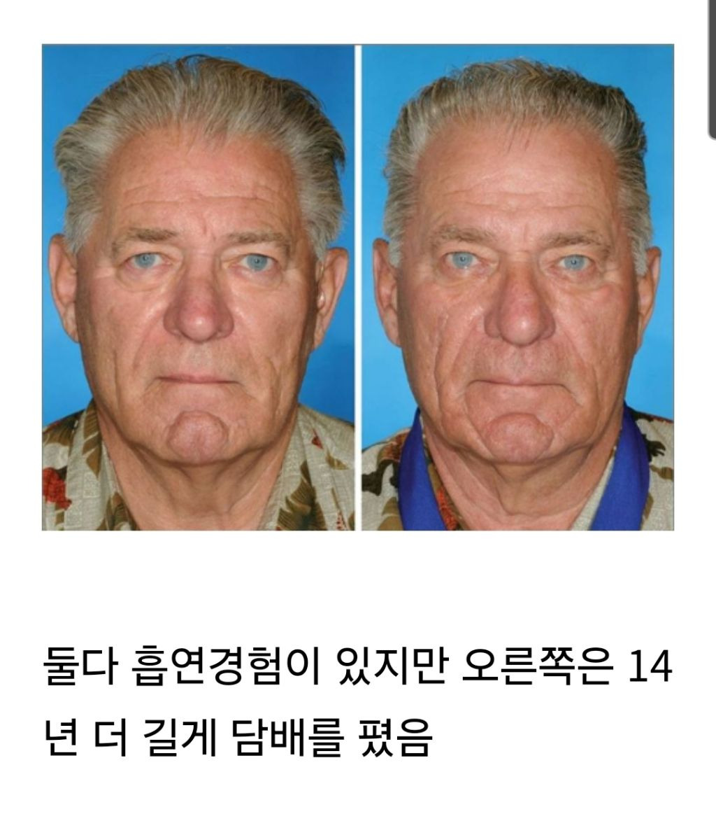 일란성 쌍둥이로 비교한 노화 - 담배, 스트레스, 햇빛, 체중변화 | 인스티즈