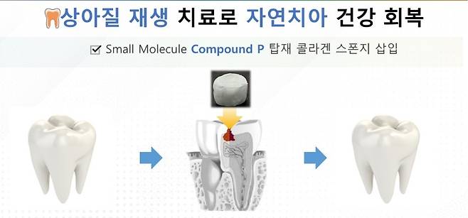 '윙~' 치아 깎는 소리 이제 그만...자연치아 만드는 혁신치료 뜬다 | 인스티즈