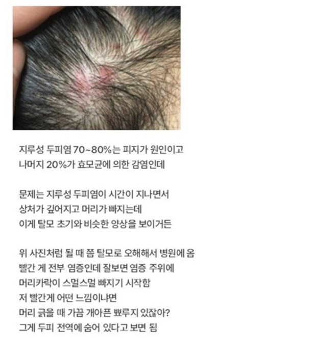 탈모라고 오해하는 질환 1위 | 인스티즈