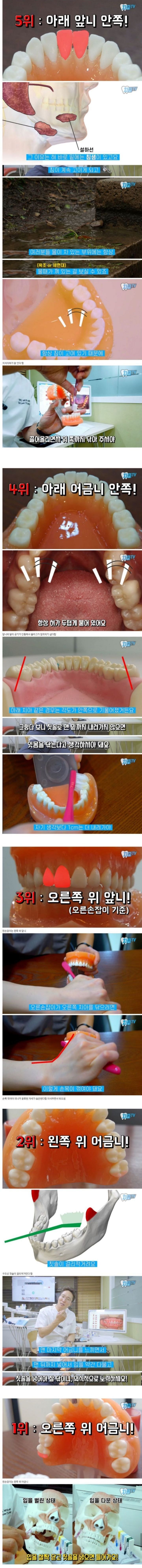 이빨 닦을때 놓치는 부위 top 5 .JPG | 인스티즈
