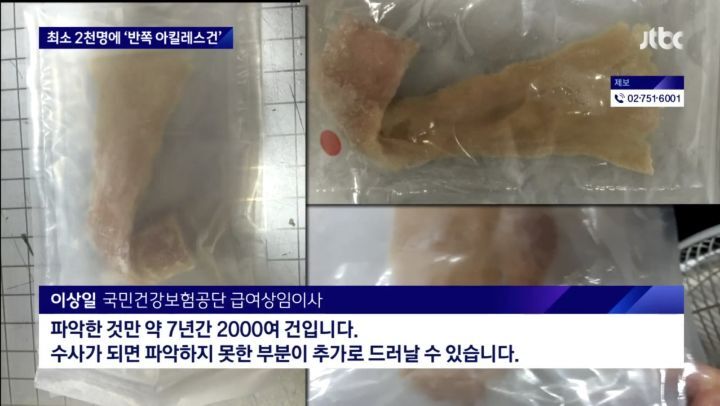 지난 7년간 십자인대 수술 받은 사람 중 무허가 인대 이식 받은 사람 최소 2천명 | 인스티즈