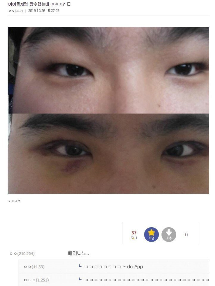 아이돌처럼 쌍수했는데 ㅁㅌㅊ? | 인스티즈