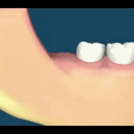 매복사랑니 피해유형 | 인스티즈