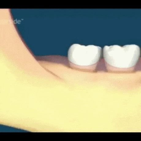 매복사랑니 피해유형 | 인스티즈