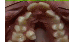 치아교정 | 인스티즈