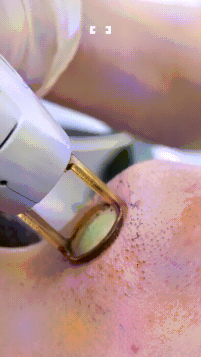 수염 레이저 제모.gif | 인스티즈