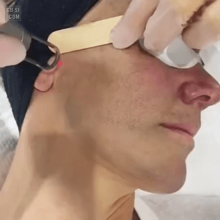 피부 레이저 시술 | 인스티즈