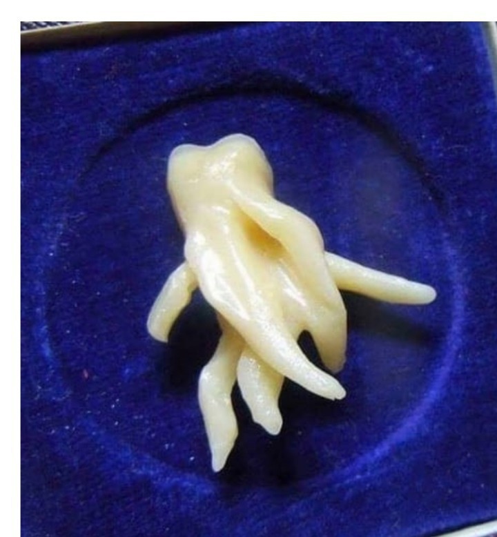 보기만해도 고통스러운 발치된사랑니 | 인스티즈