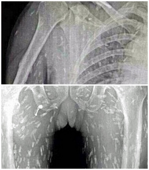(혐오주의) 생선회 먹고 기생충이 온몸에 퍼진 남성 | 인스티즈
