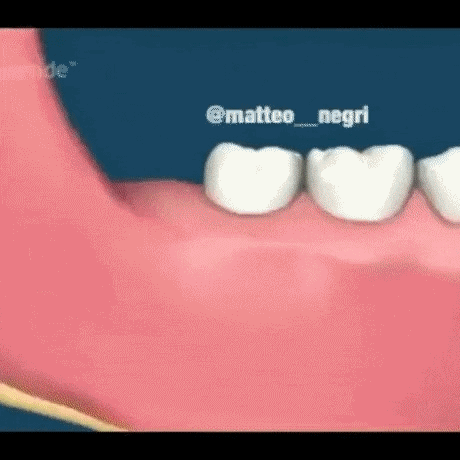 매복사랑니 피해유형 | 인스티즈