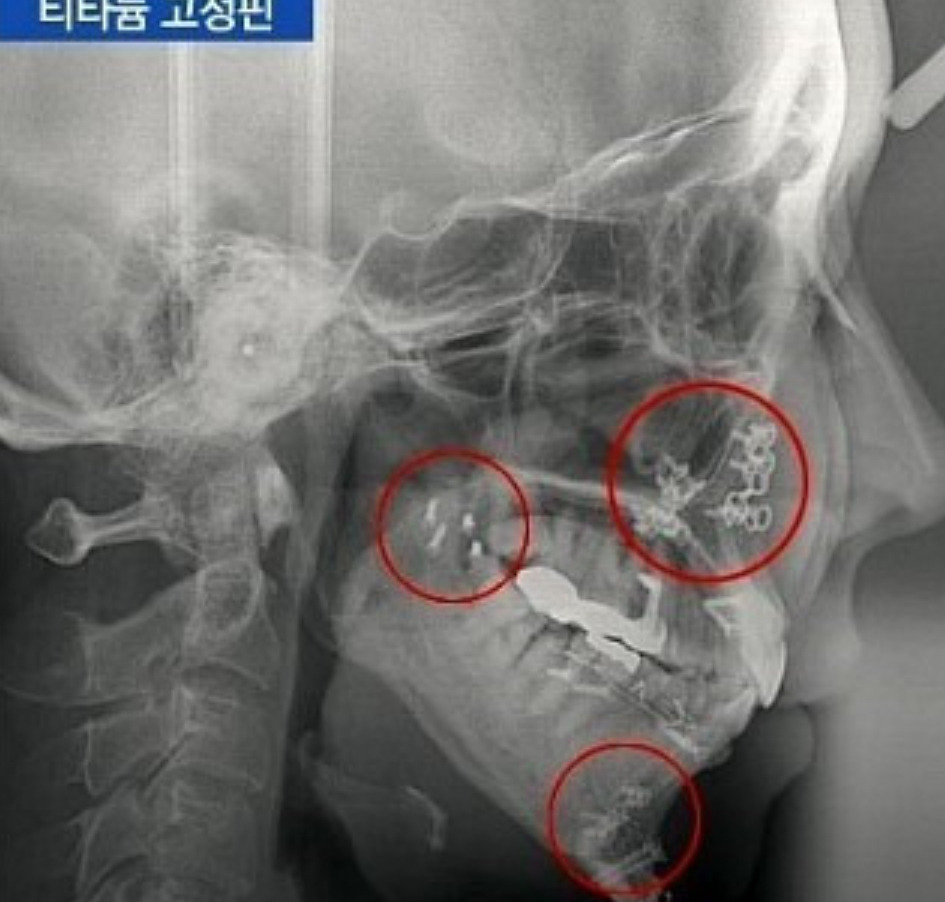 미용성형이 아닌데 한때 열풍처럼 유행했던 수술.gif | 인스티즈