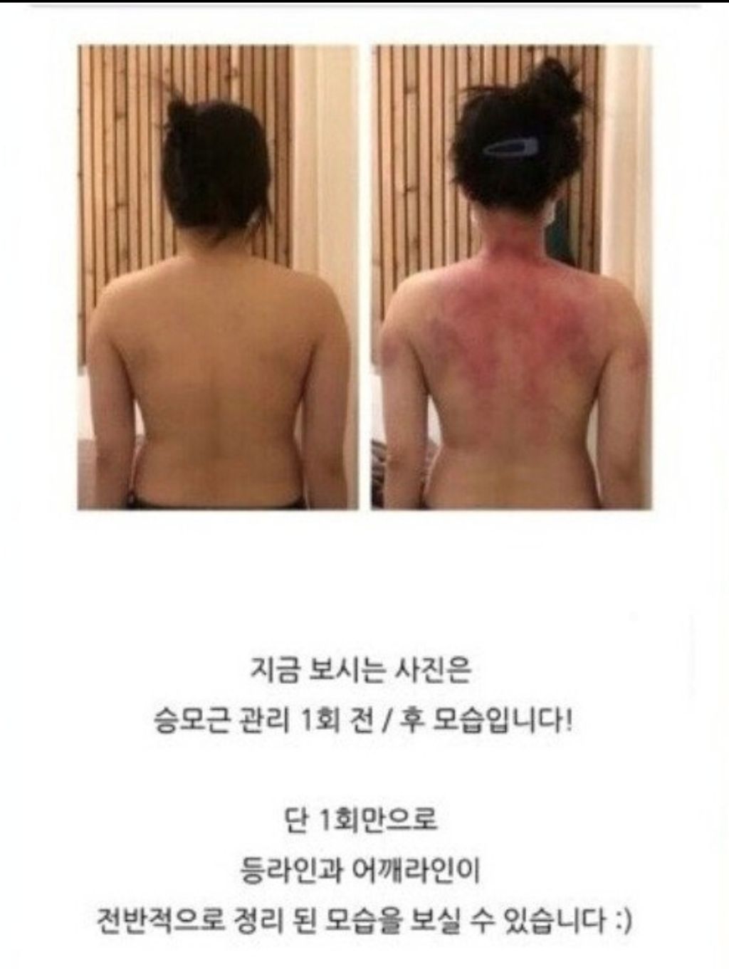 단 1회 관리만으로 등, 어깨라인 정리 | 인스티즈