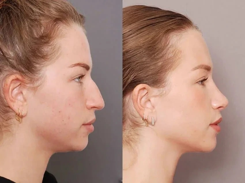 요즘 외국에서 많이 한다는 매부리코 수술 | 인스티즈