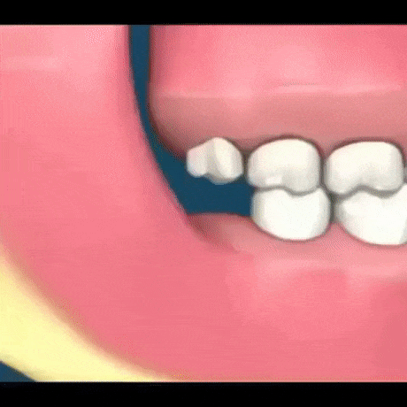 사랑니를 뽑아야 하는 이유.gif | 인스티즈