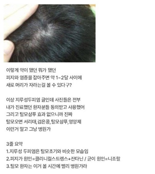 탈모라고 오해하는 질환 1위 | 인스티즈