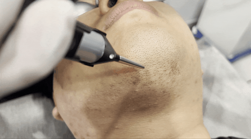 수염 레이저 제모.gif | 인스티즈