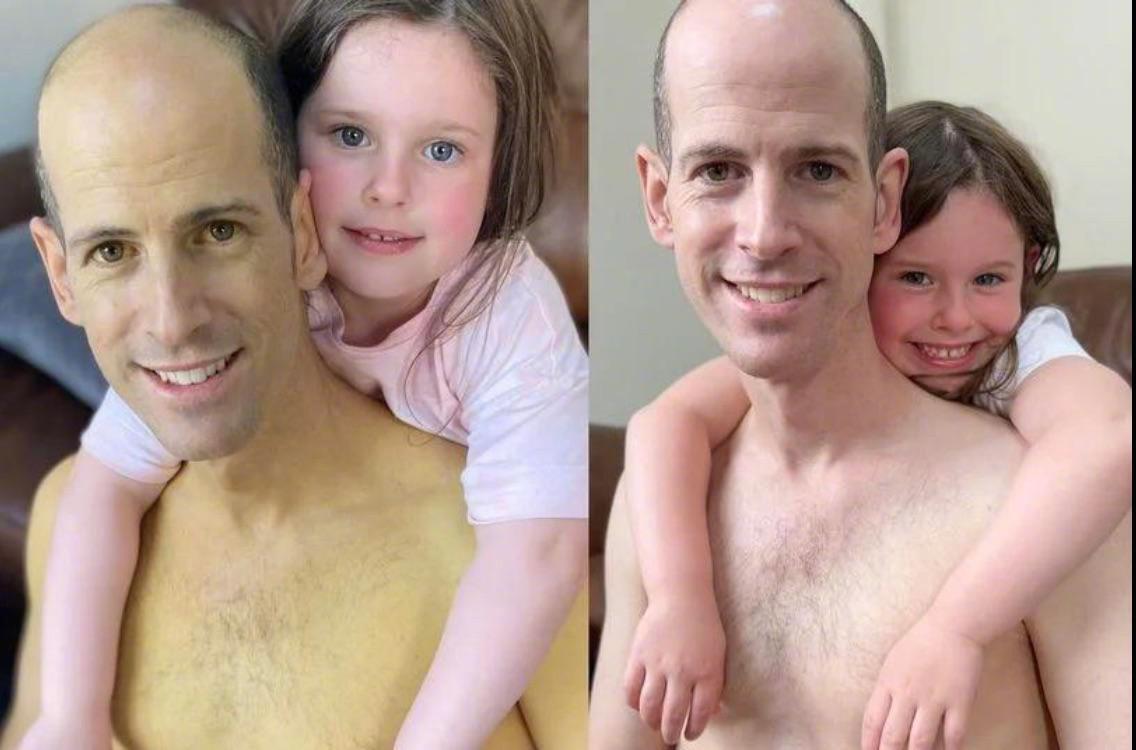 간 이식 전후 .jpg | 인스티즈